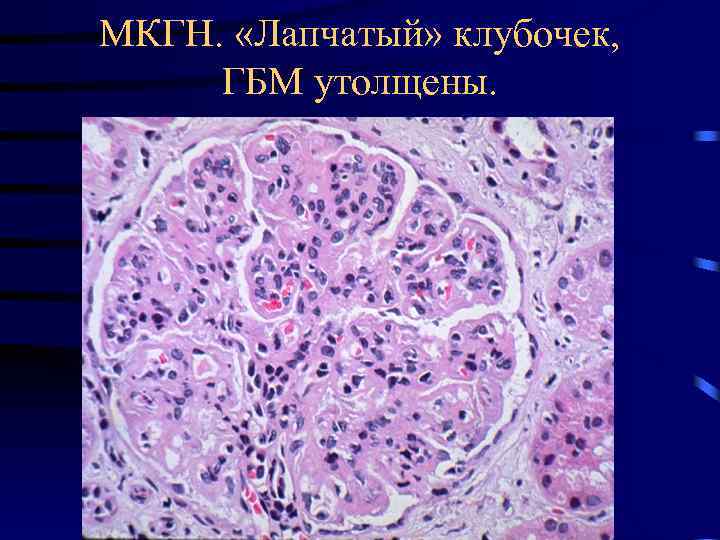 МКГН. «Лапчатый» клубочек, ГБМ утолщены. 