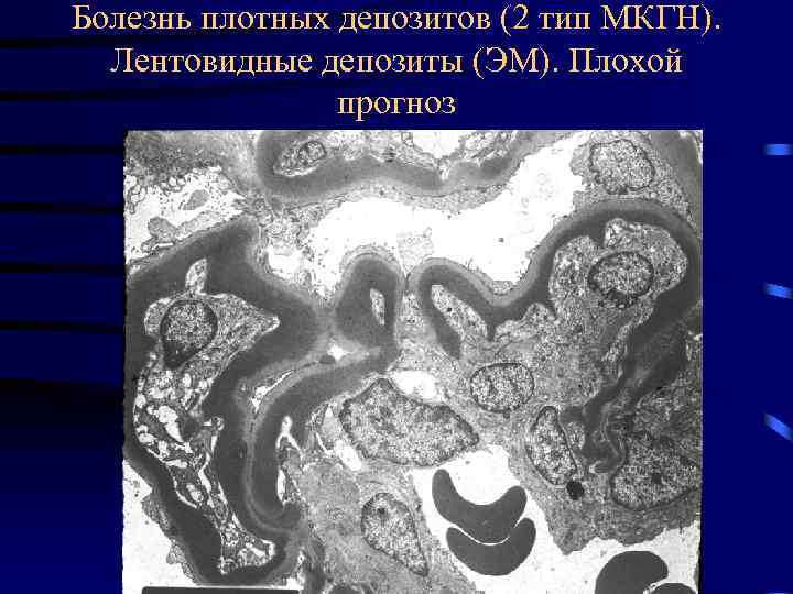 Болезнь плотных депозитов (2 тип МКГН). Лентовидные депозиты (ЭМ). Плохой прогноз 