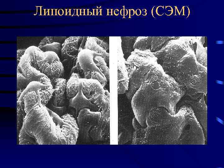 Липоидный нефроз (СЭМ) 