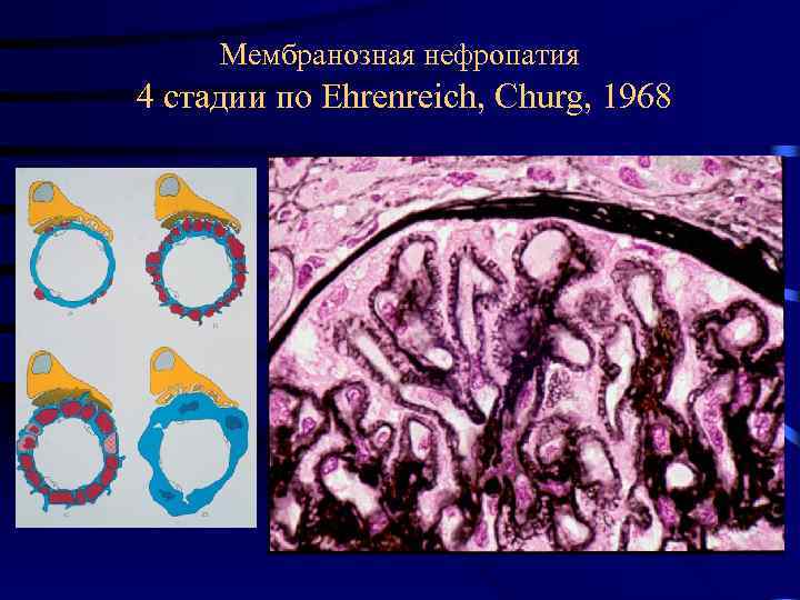 Мембранозная нефропатия 4 стадии по Ehrenreich, Churg, 1968 