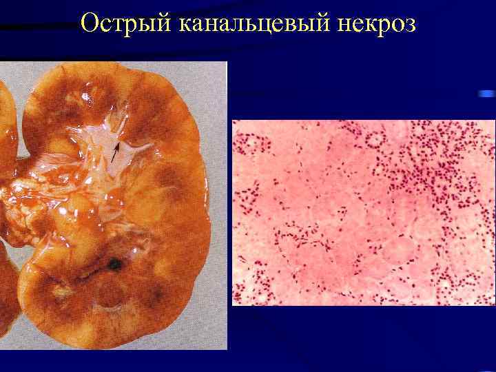 Острый канальцевый некроз 