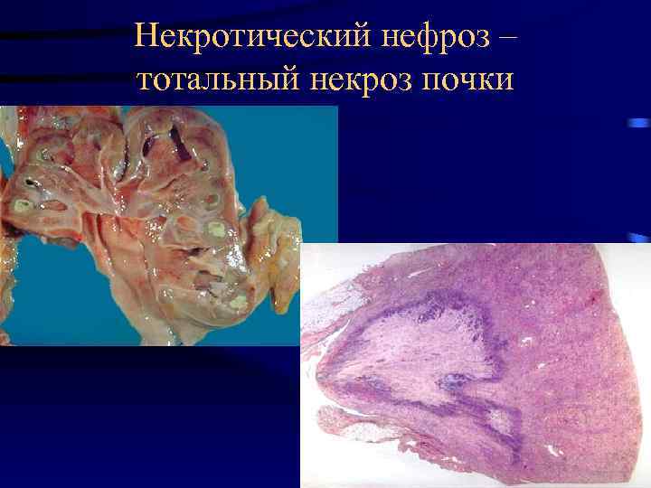 Некротический нефроз – тотальный некроз почки 