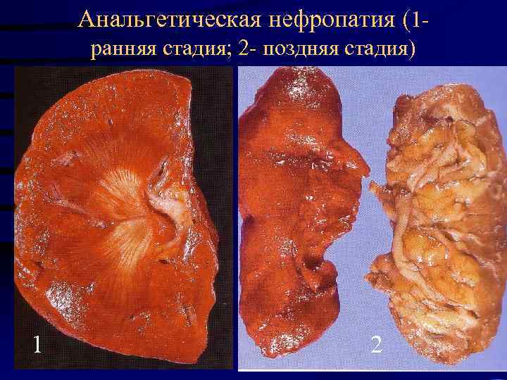 Анальгетическая нефропатия (1 ранняя стадия; 2 - поздняя стадия) 1 2 