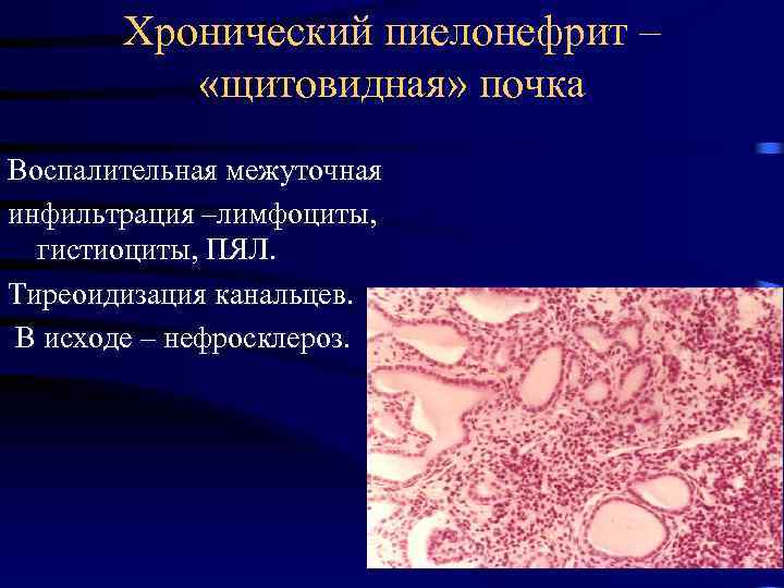 Хронический пиелонефрит – «щитовидная» почка Воспалительная межуточная инфильтрация –лимфоциты, гистиоциты, ПЯЛ. Тиреоидизация канальцев. В