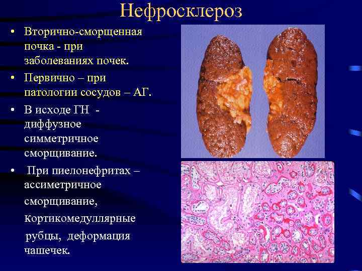 Нефросклероз • Вторично-сморщенная почка - при заболеваниях почек. • Первично – при патологии сосудов