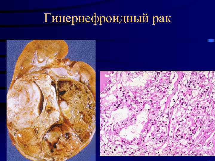 Гипернефроидный рак 