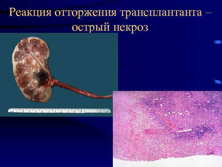 Реакция отторжения трансплантанта – острый некроз 