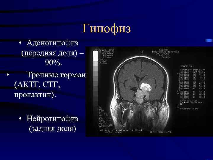 Гипофиз • Аденогипофиз (передняя доля) – 90%. • Тропные гормоны (АКТГ, СТГ, пролактин). •