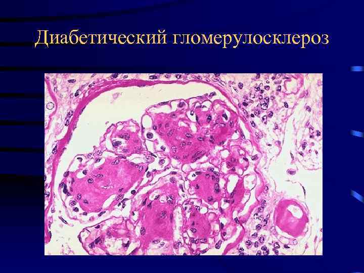 Диабетический гломерулосклероз 