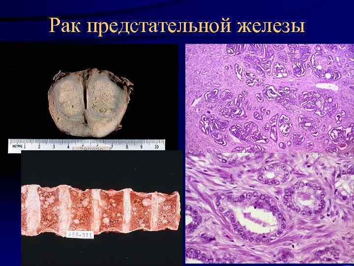 Рак предстательной железы 