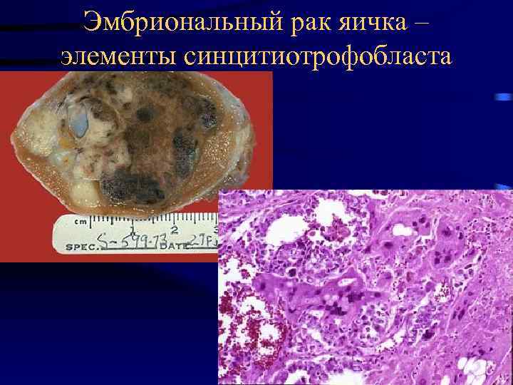 Эмбриональный рак яичка – элементы синцитиотрофобласта 