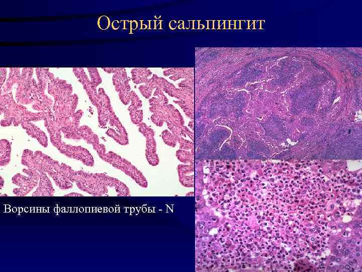 Острый сальпингит Ворсины фаллопиевой трубы - N 