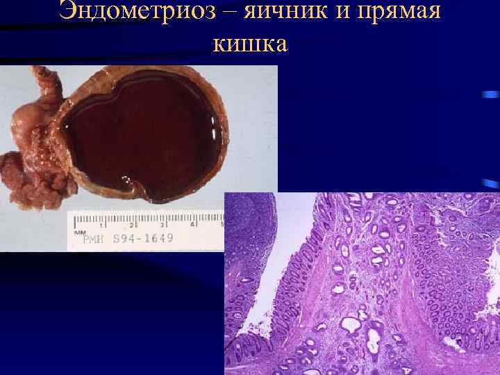 Эндометриоз – яичник и прямая кишка 