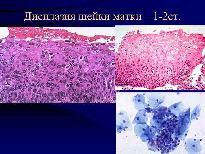 Дисплазия шейки матки – 1 -2 ст. 