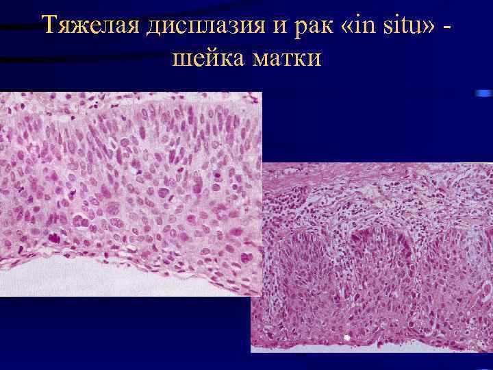 Тяжелая дисплазия и рак «in situ» шейка матки 