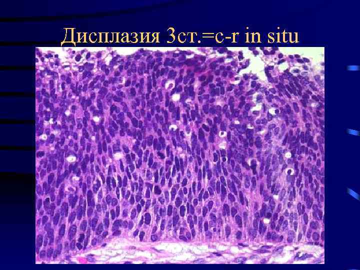 Дисплазия 3 ст. =c-r in situ 