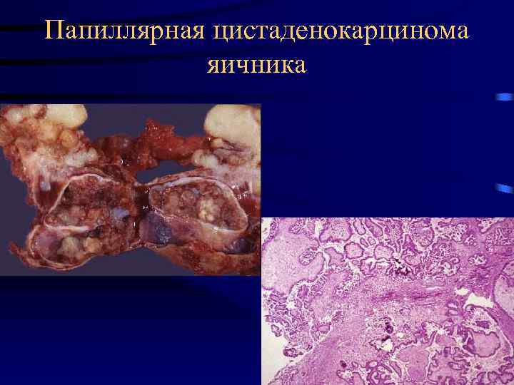 Папиллярная цистаденокарцинома яичника 