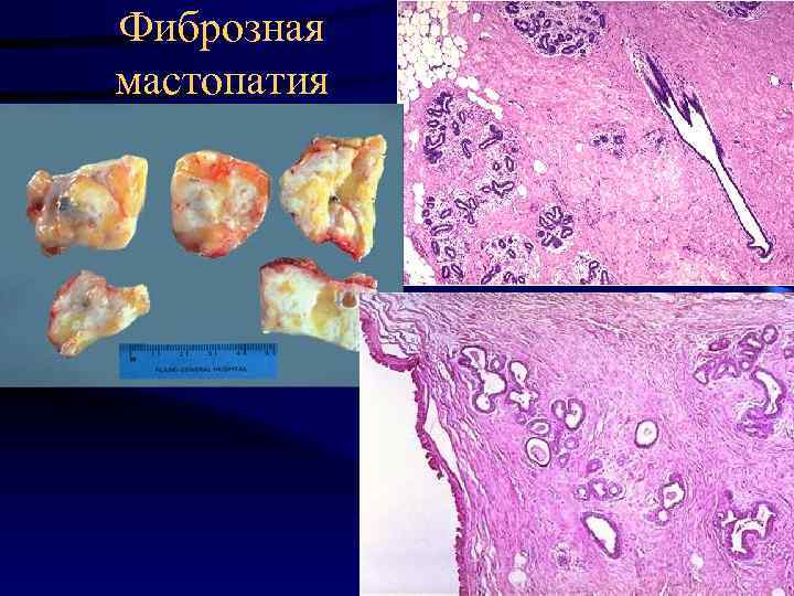 Фиброзная мастопатия 