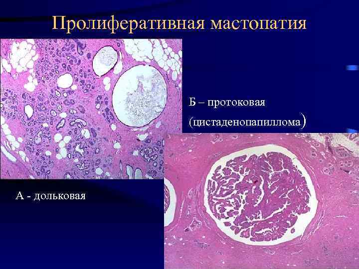 Пролиферативная мастопатия Б – протоковая (цистаденопапиллома) А - дольковая 