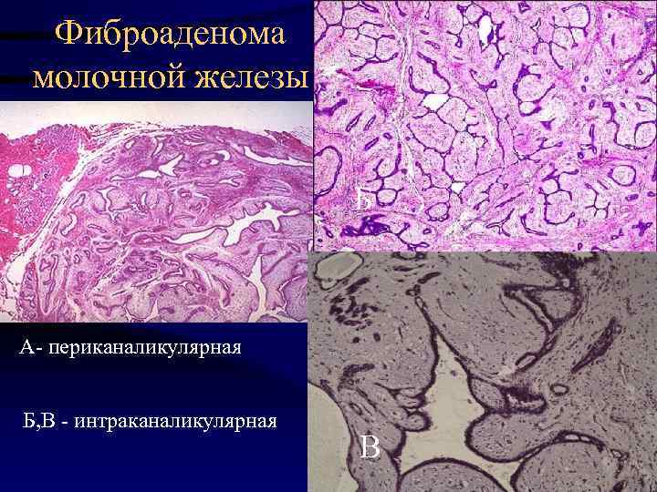 Фиброаденома молочной железы картинки