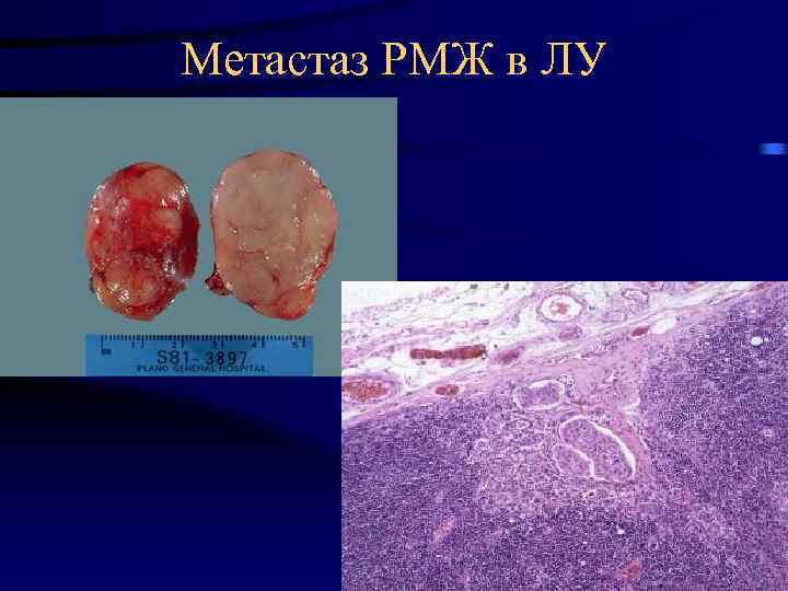 Метастаз РМЖ в ЛУ 