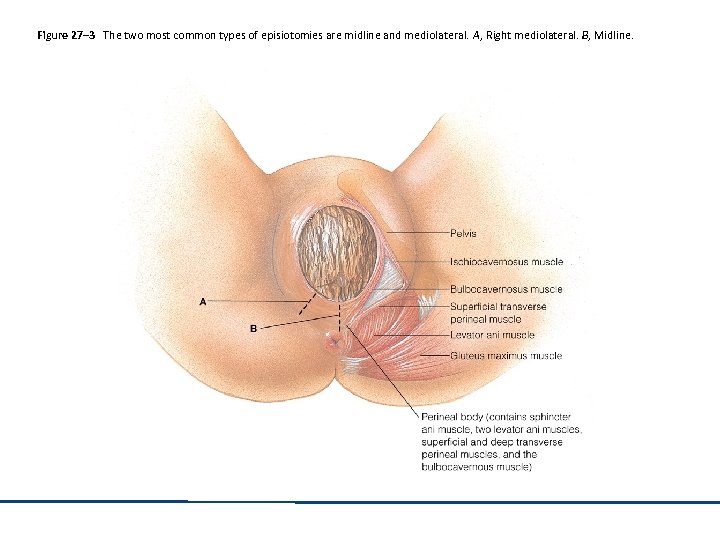 Figure 27– 3 The two most common types of episiotomies are midline and mediolateral.