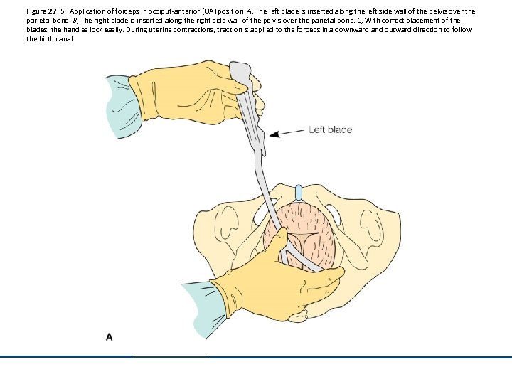 Figure 27– 5 Application of forceps in occiput-anterior (OA) position. A, The left blade