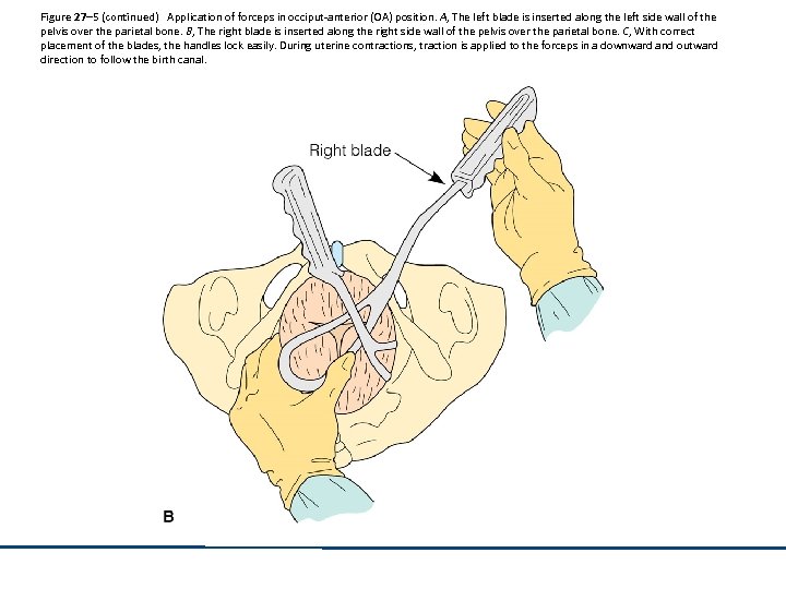 Figure 27– 5 (continued) Application of forceps in occiput-anterior (OA) position. A, The left