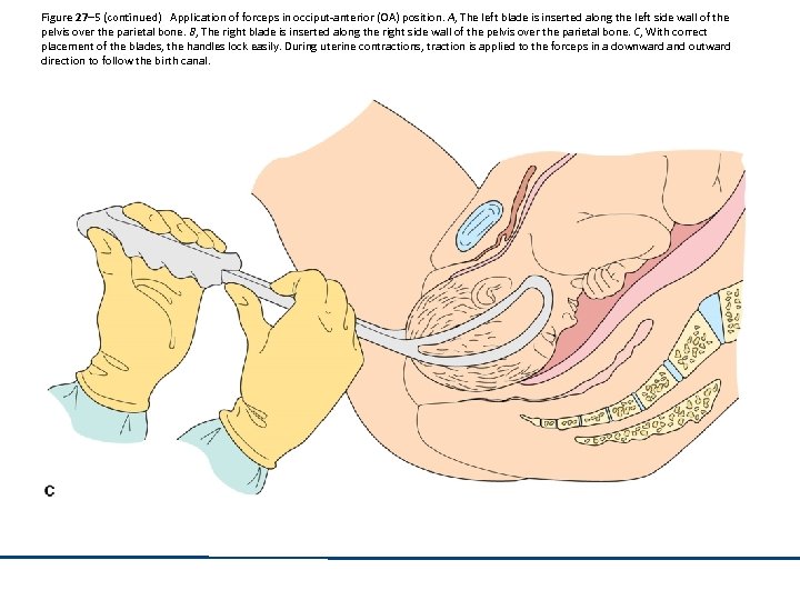 Figure 27– 5 (continued) Application of forceps in occiput-anterior (OA) position. A, The left