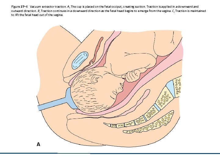 Figure 27– 6 Vacuum extractor traction. A, The cup is placed on the fetal