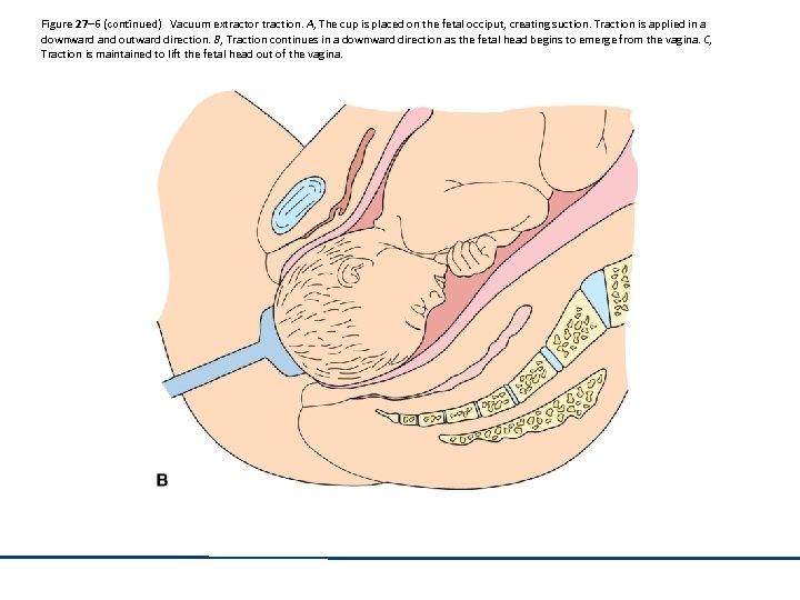 Figure 27– 6 (continued) Vacuum extractor traction. A, The cup is placed on the