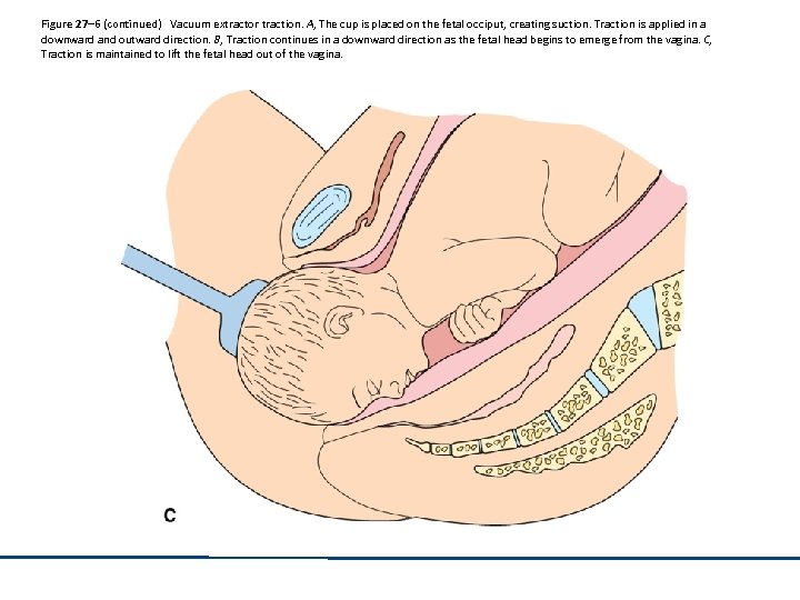 Figure 27– 6 (continued) Vacuum extractor traction. A, The cup is placed on the