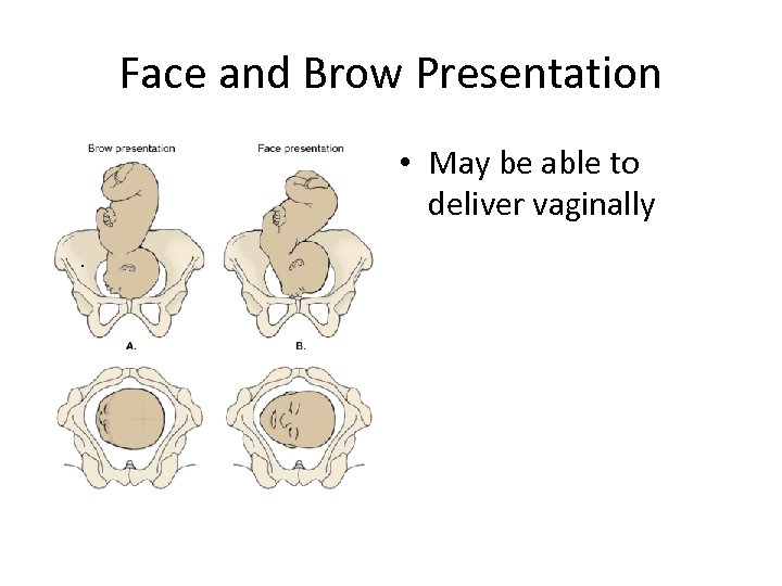 Face and Brow Presentation • May be able to deliver vaginally. 