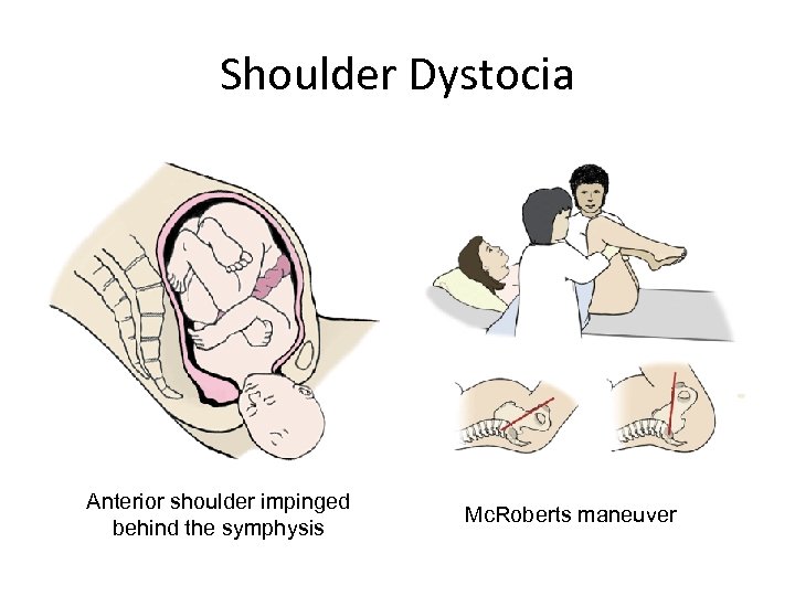 Shoulder Dystocia Anterior shoulder impinged behind the symphysis Mc. Roberts maneuver 