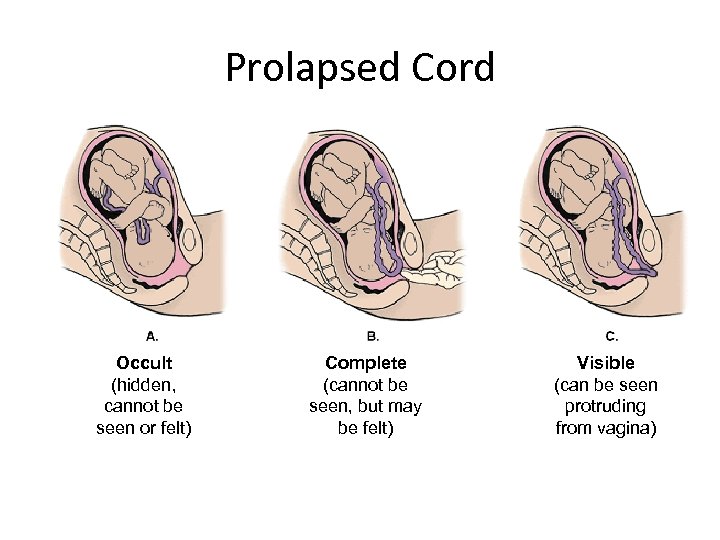 Prolapsed Cord Occult (hidden, cannot be seen or felt) Complete (cannot be seen, but