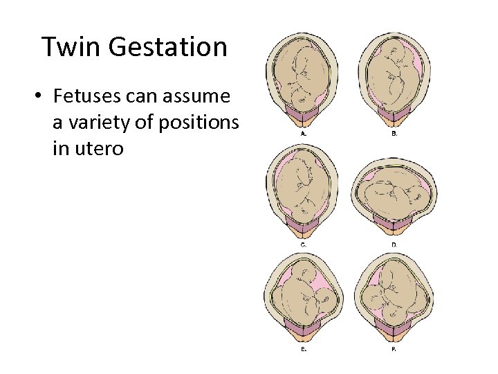 Twin Gestation • Fetuses can assume a variety of positions in utero 