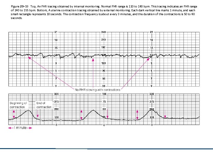 Figure 23– 10 Top, An FHR tracing obtained by internal monitoring. Normal FHR range