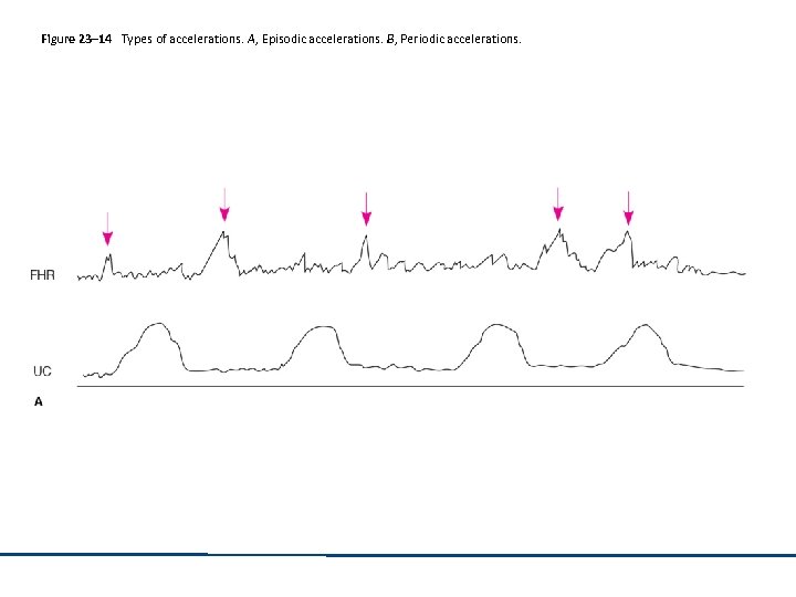 Figure 23– 14 Types of accelerations. A, Episodic accelerations. B, Periodic accelerations. 