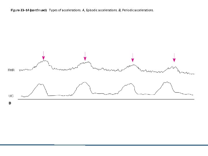 Figure 23– 14 (continued) Types of accelerations. A, Episodic accelerations. B, Periodic accelerations. 