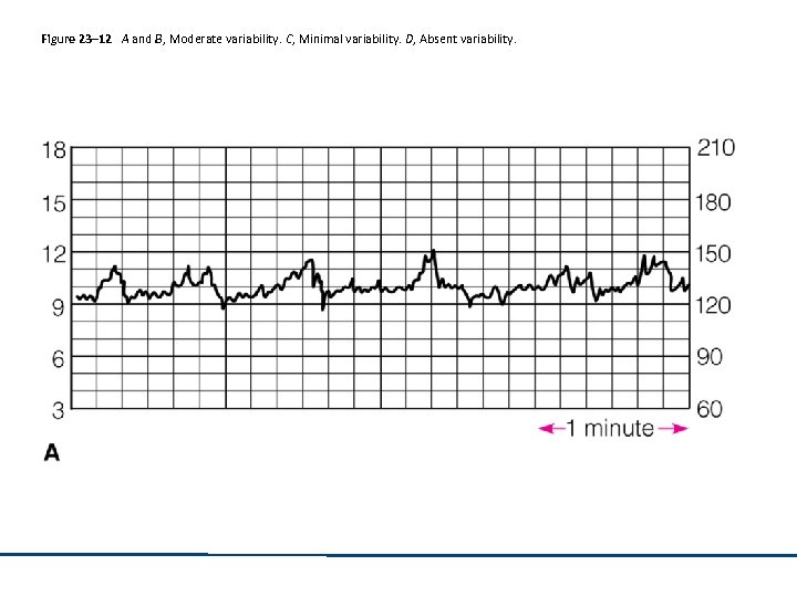 Figure 23– 12 A and B, Moderate variability. C, Minimal variability. D, Absent variability.