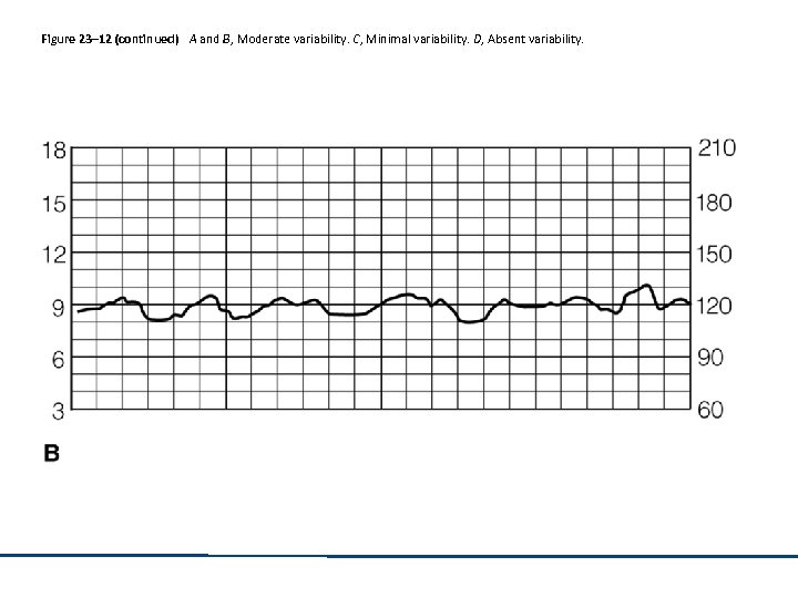 Figure 23– 12 (continued) A and B, Moderate variability. C, Minimal variability. D, Absent