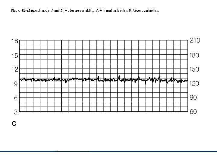 Figure 23– 12 (continued) A and B, Moderate variability. C, Minimal variability. D, Absent