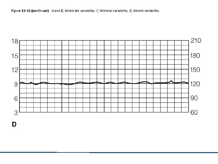 Figure 23– 12 (continued) A and B, Moderate variability. C, Minimal variability. D, Absent