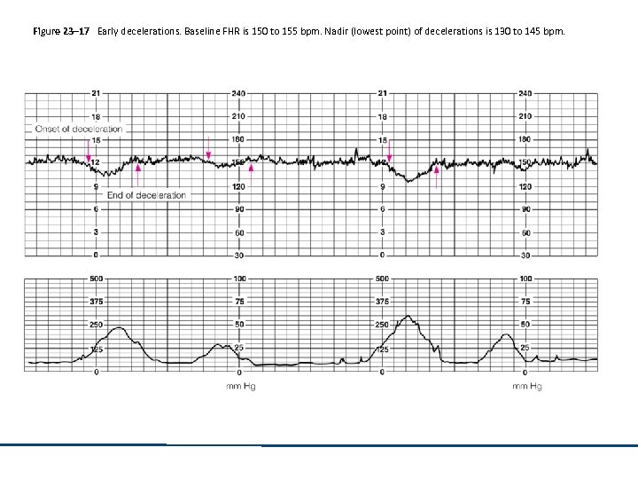 Figure 23– 17 Early decelerations. Baseline FHR is 150 to 155 bpm. Nadir (lowest