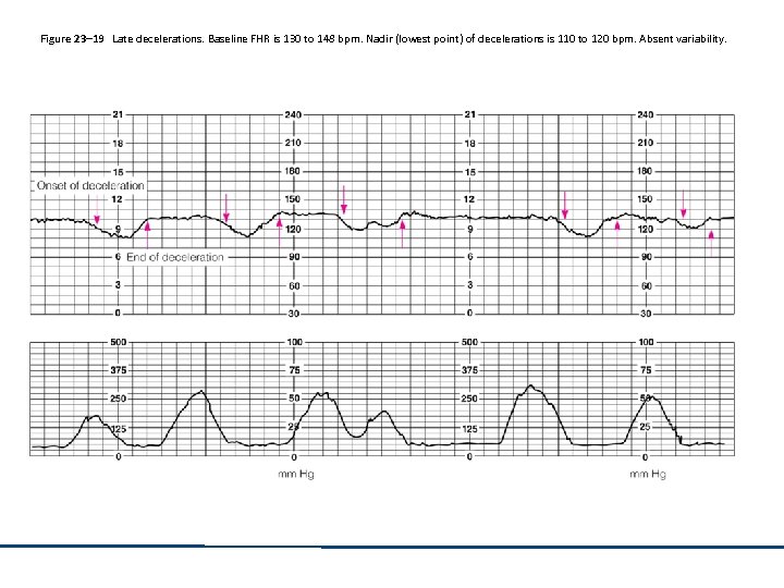 Figure 23– 19 Late decelerations. Baseline FHR is 130 to 148 bpm. Nadir (lowest