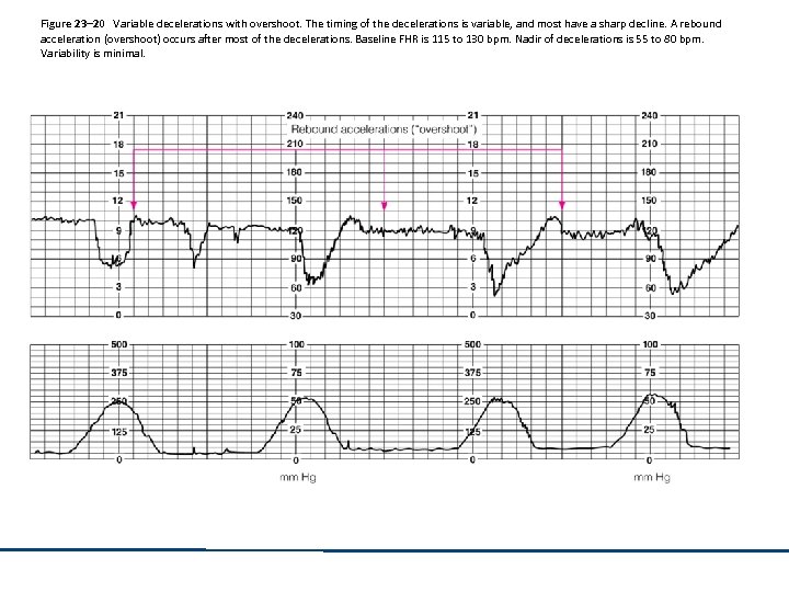 Figure 23– 20 Variable decelerations with overshoot. The timing of the decelerations is variable,