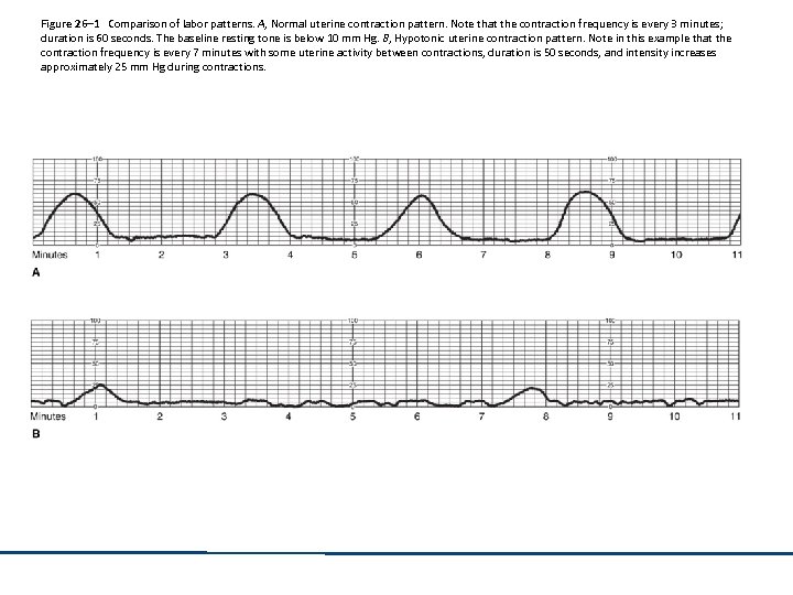 Figure 26– 1 Comparison of labor patterns. A, Normal uterine contraction pattern. Note that