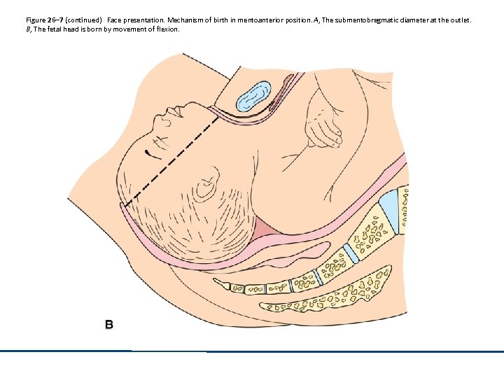 Figure 26– 7 (continued) Face presentation. Mechanism of birth in mentoanterior position. A, The