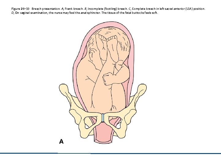 Figure 26– 10 Breech presentation. A, Frank breech. B, Incomplete (footling) breech. C, Complete