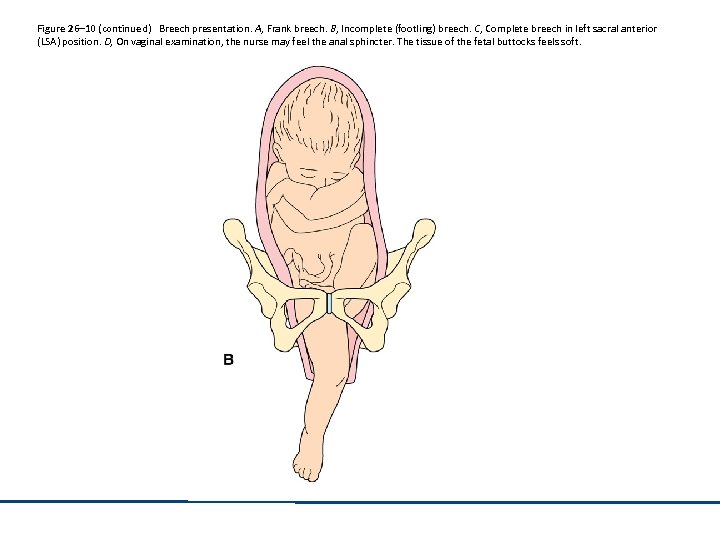 Figure 26– 10 (continued) Breech presentation. A, Frank breech. B, Incomplete (footling) breech. C,